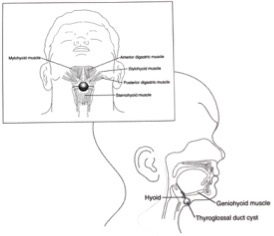 Chisturile și fistula gâtului la copii - Departamentul de Chirurgie Toracică a Copilului din Moscova
