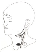 Chisturile și fistula gâtului la copii - Departamentul de Chirurgie Toracică a Copilului din Moscova