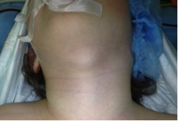 Ciszták és a nyak fisztulája gyermekeknél - Gyermek mellkasi sebészet tanszéke Moszkvában
