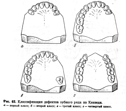 Clasificarea defectelor dentiției