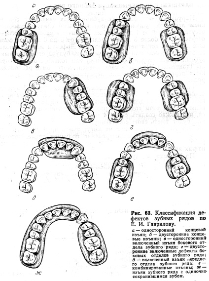 Clasificarea defectelor dentiției