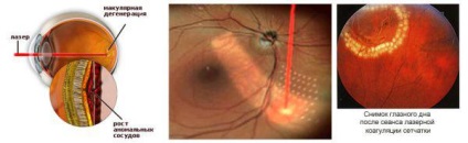 Coagularea cu laser a retinei ochiului consecințele intervenției chirurgicale, după perioada postoperatorie, după ce este imposibil,
