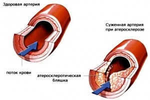 Atherosclerosis kezelése népi gyógymódokkal - szívkezelés