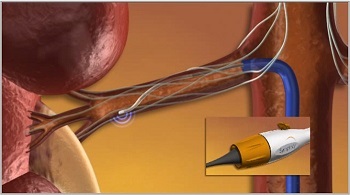 Tratamentul hipertensiunii arteriale în Israel, clinica 