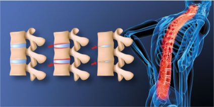 Tratamentul unei hernie a coloanei vertebrale, terapeutul manual, osteopat