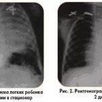 Tratamentul pneumoniei la copii la domiciliu cu remedii folclorice, micoplasmatice,