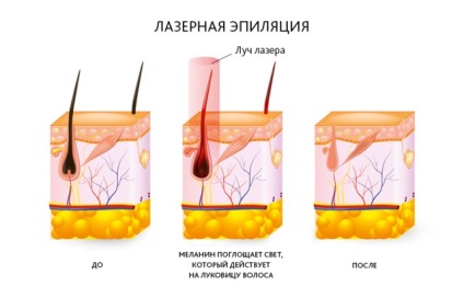 A lézeres szőrtelenítés legjobb klinikája, Josephine