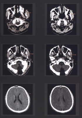 Imagistica prin rezonanță magnetică a creierului
