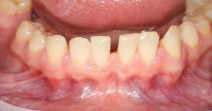 Vestibulul mic al simptomelor și consecințelor cavității bucale, metodele de corectare