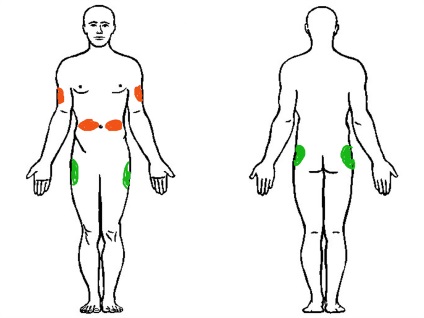 Locurile și tehnica administrării insulinei