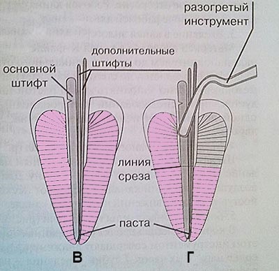 Metoda de condensare laterală