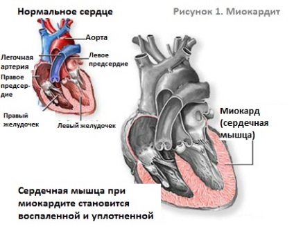 Miocardită miocardită acută, miocardită infecțioasă