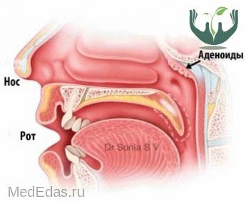 Este posibil să se facă față cu adenoide fără intervenție chirurgicală, publicații privind tratamentul homeopatiei și osteopatiei,