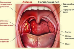 Rețete populare pentru angina pectorală