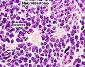 Neuroblastomul - diagnostic și tratament în Clinica Herzliya