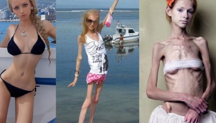 Anorexia nervoasă simptome, semne, tratament, înainte și după fotografii, boli psihice