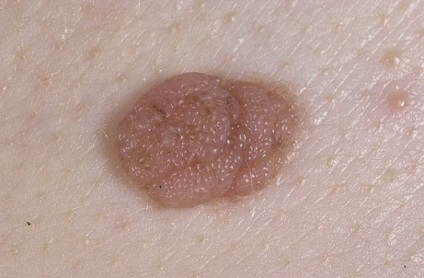 Nevus și diferențele de melanom, degenerare, factori de risc, prevenire, video