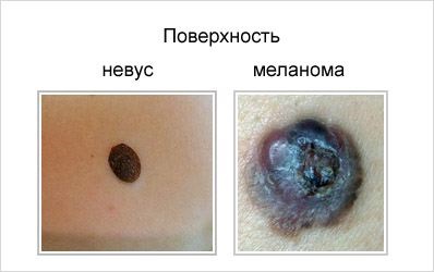 Nevus și diferențele de melanom, degenerare, factori de risc, prevenire, video
