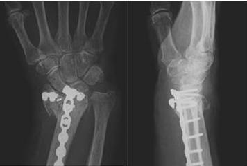 Tratamentul chirurgical al fracturilor distal ale razei