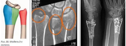 Tratamentul chirurgical al fracturilor distal ale razei