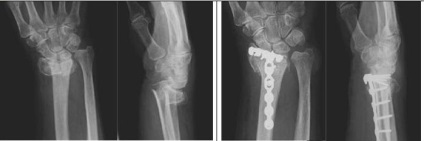 Tratamentul chirurgical al fracturilor distal ale razei