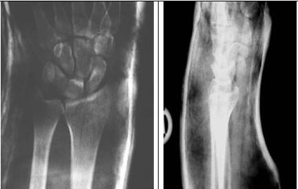 Tratamentul chirurgical al fracturilor distal ale razei