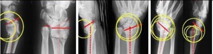 Tratamentul chirurgical al fracturilor distal ale razei