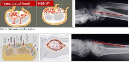 Tratamentul chirurgical al fracturilor distal ale razei