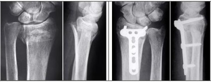 Tratamentul chirurgical al fracturilor distal ale razei