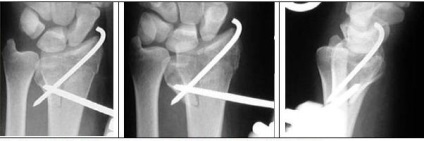 Tratamentul chirurgical al fracturilor distal ale razei