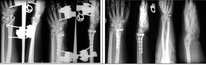 Tratamentul chirurgical al fracturilor distal ale razei