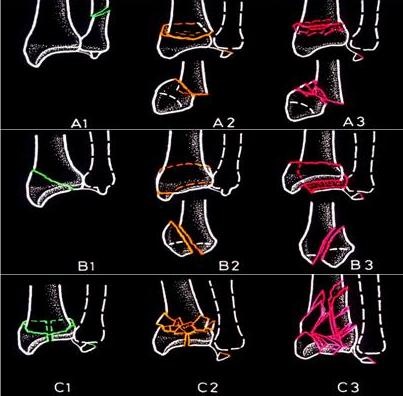 Tratamentul chirurgical al fracturilor distal ale razei