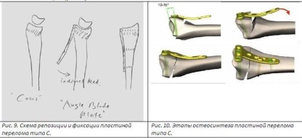 Tratamentul chirurgical al fracturilor distal ale razei