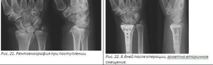 Tratamentul chirurgical al fracturilor distal ale razei