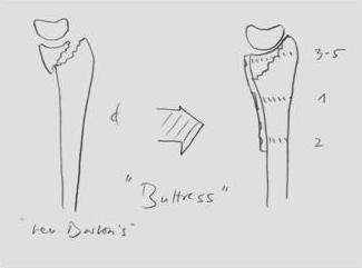 Tratamentul chirurgical al fracturilor distal ale razei