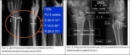 Tratamentul chirurgical al fracturilor distal ale razei