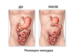 Chirurgie pentru ulcerul stomacal
