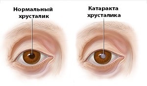 Operațiunea de înlocuire a lentilei ochiului