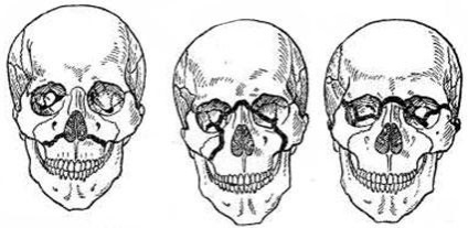 Fractura maxilarului superior - clasificare, caracteristici ale imaginii clinice și tratament