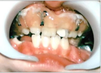 Fractura maxilarului superior - clasificare, caracteristici ale imaginii clinice și tratament