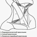 Fractura maxilarului superior - clasificare, caracteristici ale imaginii clinice și tratament