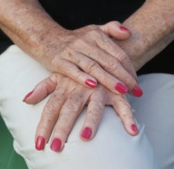 Pete pigmentate pe mâinile tratamentului, motivele pentru care trebuie să scăpăm