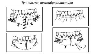 Plasticitatea vestibulului cavității orale (vestibuloplastia conform edlan-meikher) ce este