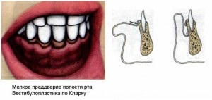 Plasticitatea vestibulului cavității orale (vestibuloplastia conform edlan-meikher) ce este