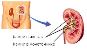Simptomele colicului renal, cauze, tratamentul colicii renale