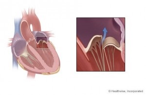 Simptome ale bolii cardiace