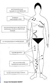 Lipitoare cu hipertensiune arterială - tratament cardiac