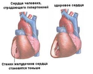 Формулиране на пиявици в хипертония - лечение на сърдечна