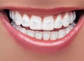 Puneți bretele pe dinți - un ortodont de copii în Kazan