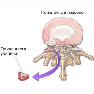 Herniile vertebrale cum să tratăm